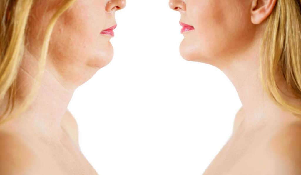 Double Chin treatment Westcliff-on-Sea before and after results