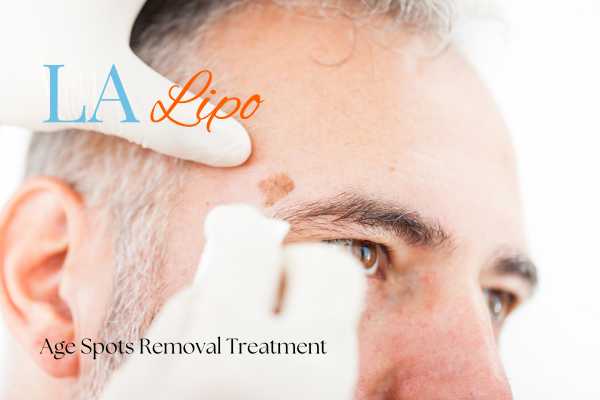 What Are the Most Effective Treatments for Age Spots Westcliff-on-Sea?