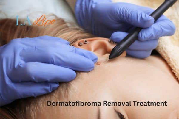 Dermatofibroma Removal Treatment Westcliff-on-Sea