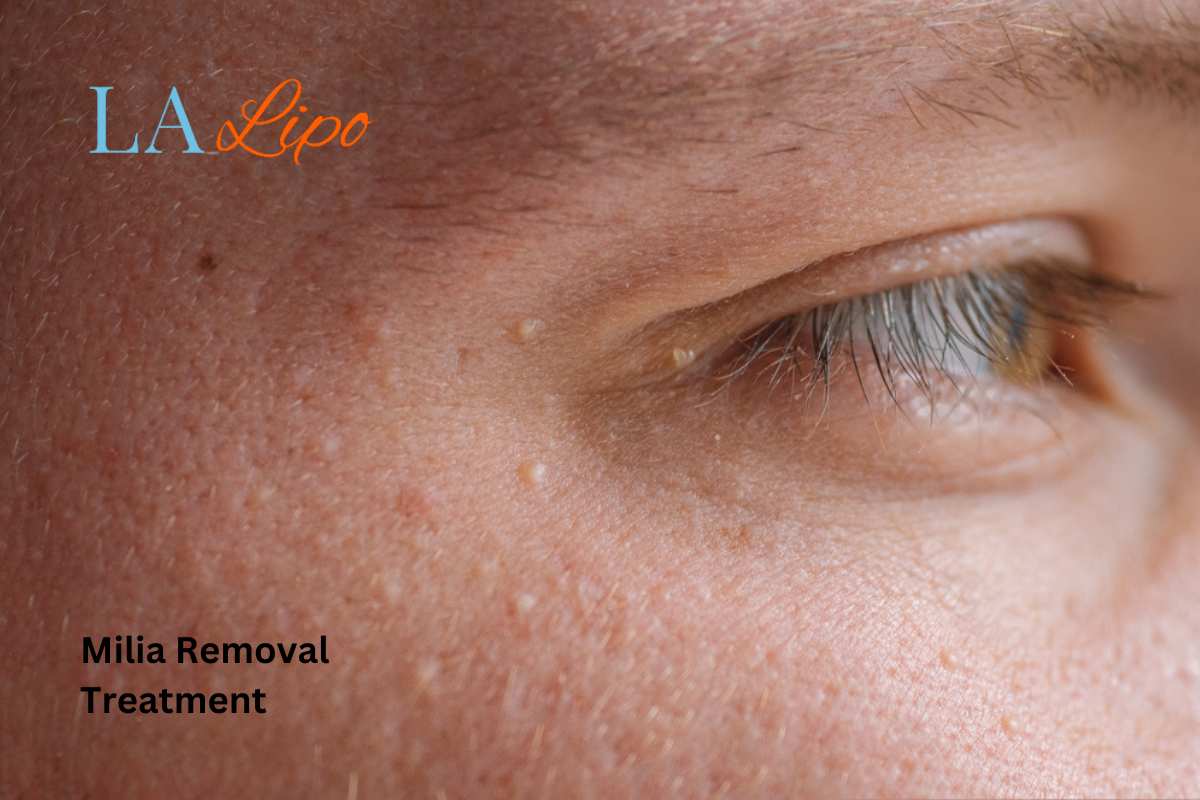 Cryopen Milia Removal: Is It the Easiest and Safest Option Westcliff-on-Sea?