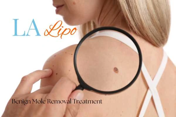 Why getting moles removed Westcliff-on-Sea can boost your confidence!