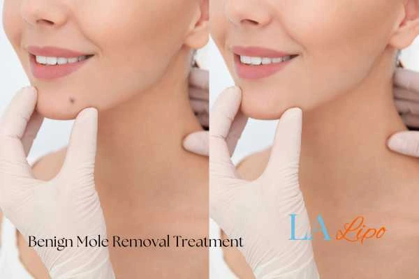 woman's before and after mole removal Westcliff-on-Sea results