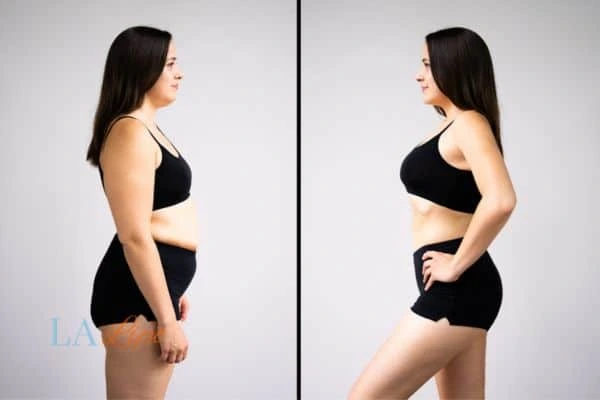 image of woman before and after results of LA-EMS Body Sculpting Westcliff-on-Sea to help treat Diastasis recti
