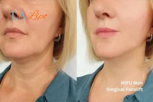 hi-fu for wrinkles Westcliff-on-Sea before and after results