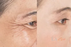 Before and after results of woman - HI-fu wrinkles reduction treatment Westcliff-on-Sea