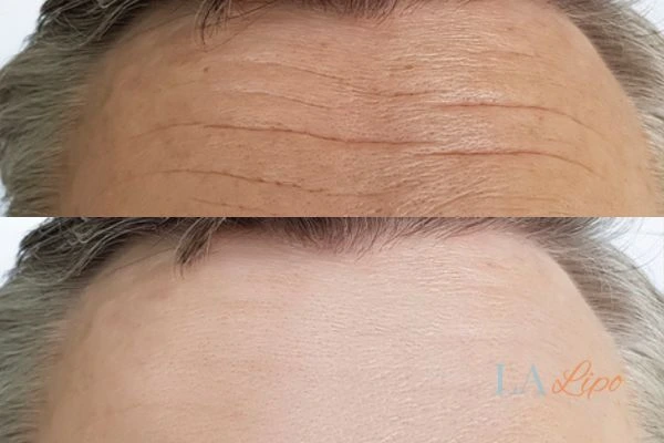 results of HIFU Westcliff-on-Sea on mans forehead to help reduce lines and wrinkles