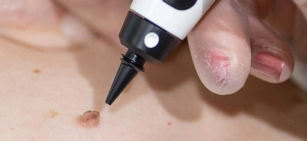 skin tag removal using cryopen Westcliff-on-Sea