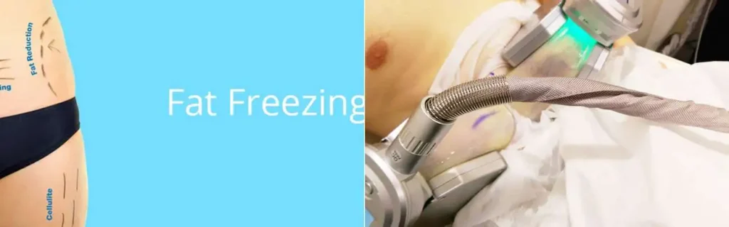 Fat freezing Westcliff-on-Sea on multiple areas of the body