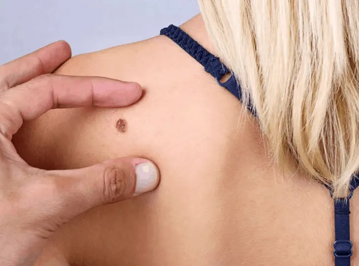 woman having mole removal Westcliff-on-Sea consultation before treatment.