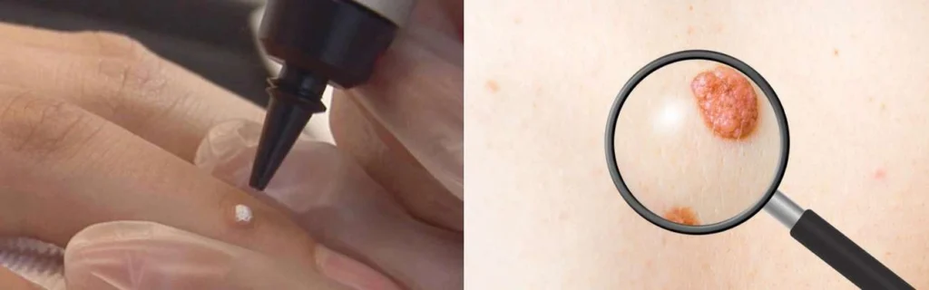 Person getting moles removed with cryopen Westcliff-on-Sea