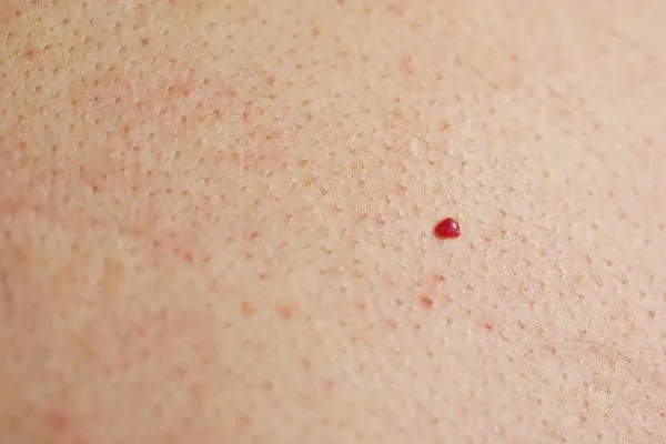 close up of a cherry angioma Westcliff-on-Sea