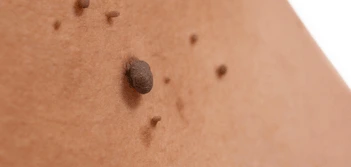 image of a skin tag Westcliff-on-Sea