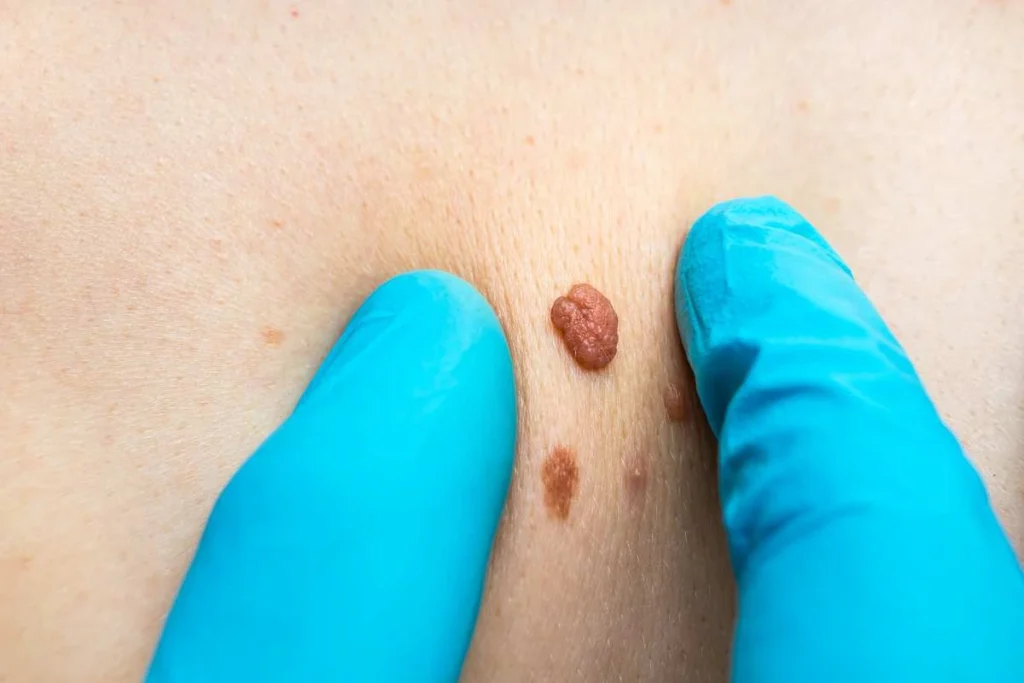 Consultant examining a skin tag Westcliff-on-Sea