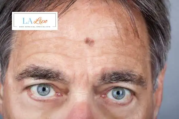 Solar Lentigo Removal Westcliff-on-Sea image of man with mark on his forehead