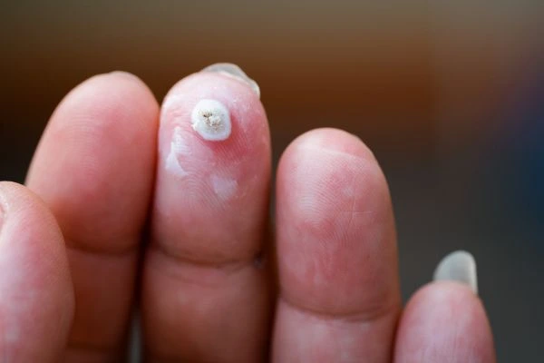 wart on person finger - cryotherapy to treat from LA LIPO Westcliff-on-Sea
