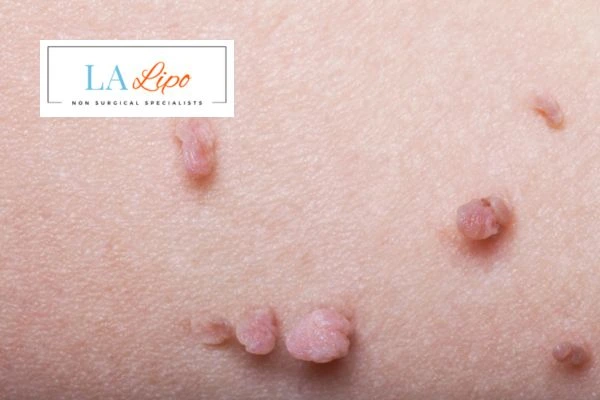 Does cryopen skin tag removal Westcliff-on-Sea hurt? Find out now call our team today!