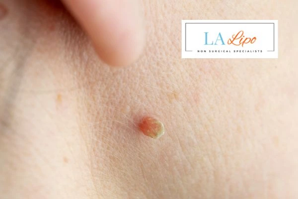Book skin tag removal Westcliff-on-Sea today speak to our team now!