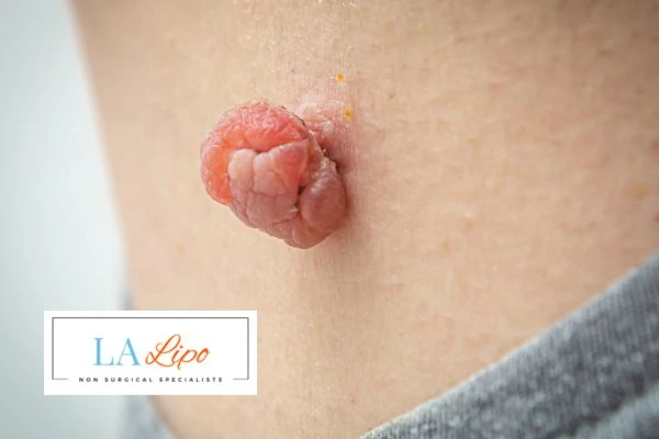Interested in skin tag removal Westcliff-on-Sea? Concerned about the pain? Find out more today!