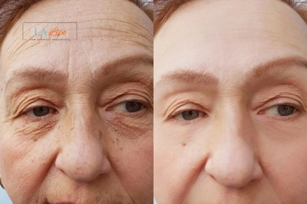 The powerful benefits of Morpheus8 Treatment Westcliff-on-Sea - Call Our team today!