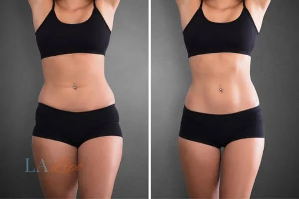 before and after results of non-surgical treatment to help a woman's body image and mental health Westcliff-on-Sea