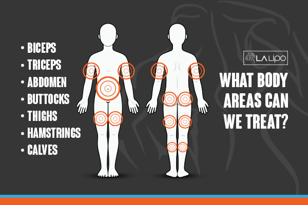 Diagram to show areas you can have LA-EMS Body Sculpting Treatment Westcliff-on-Sea