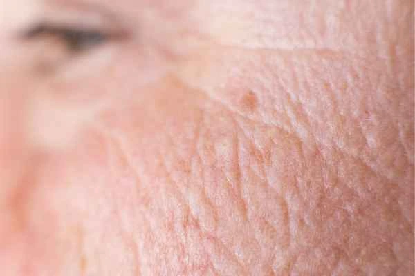 close up picture of a woman's face showing an age spot Westcliff-on-Sea