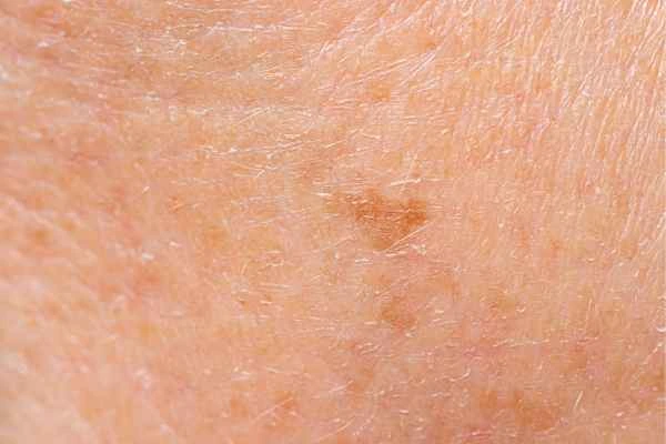 close up picture of age spots Westcliff-on-Sea