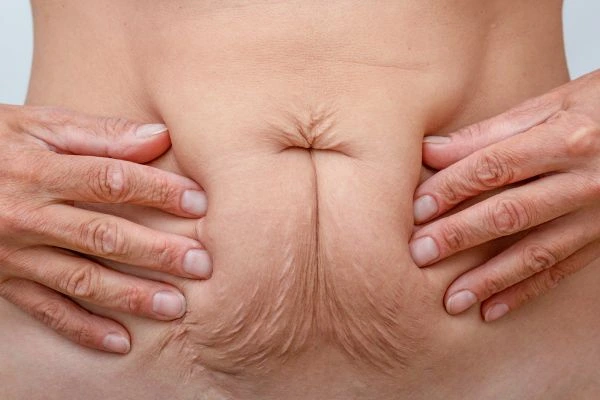 Image of a woman's stomach with loose skin - example of skin tightening Westcliff-on-Sea options