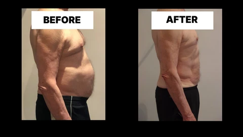 What Symptoms Can Diastasis Recti Cause in Men? Weak Core, Back Pain and Poor Posture Westcliff-on-Sea